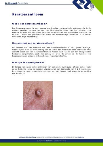 Keratoacanthoom.pdf - St. Elisabeth Ziekenhuis