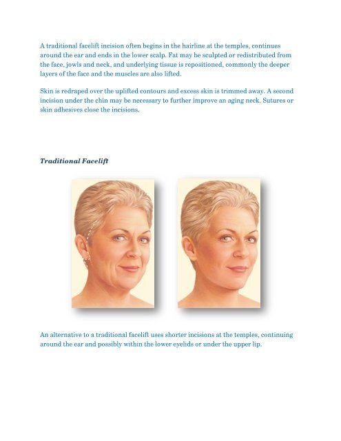 Facelift - Malychef Clinic