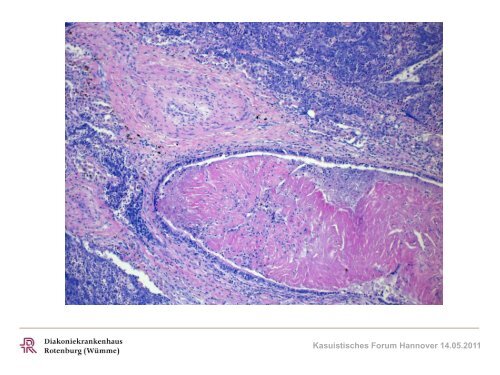 Pathologisches Institut, Klinikum Nordstadt, C. Bersch - Klinikum ...