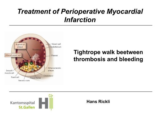 Treatment of perioperative myocardial infarction - European Society ...