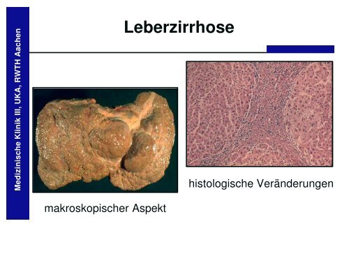 Leberzirrhose