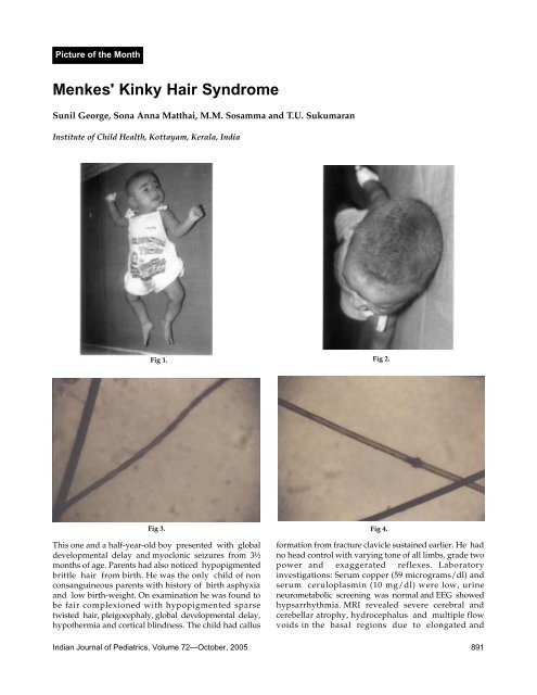 Scattered and hypopigmented scalp hairs in Menkes disease  Download  Scientific Diagram