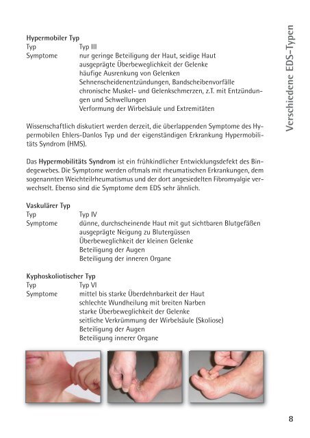 EHLERS-DANLOS-Syndrom ...Akrobaten wider Willen - Patienten ...