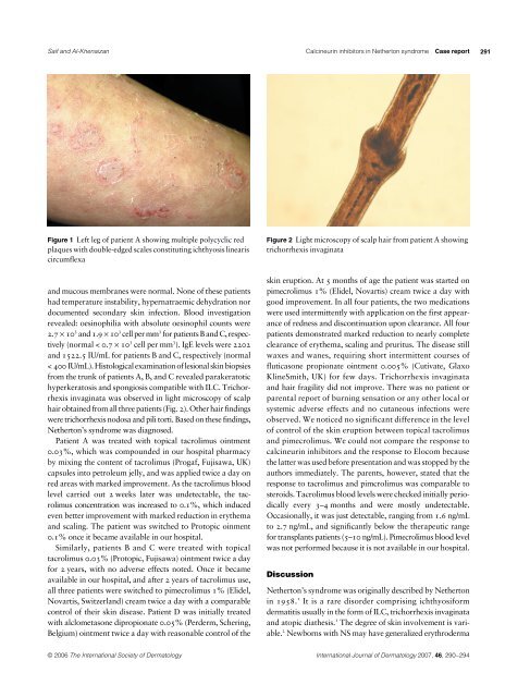 Netherton syndrome: Successful use of topical tacrolimus ... - Colleges