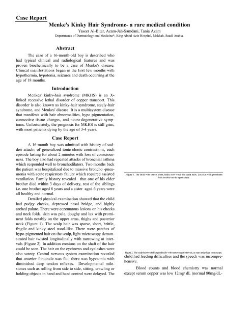 Case Report Menke S Kinky Hair Syndrome A Rare Medical Condition