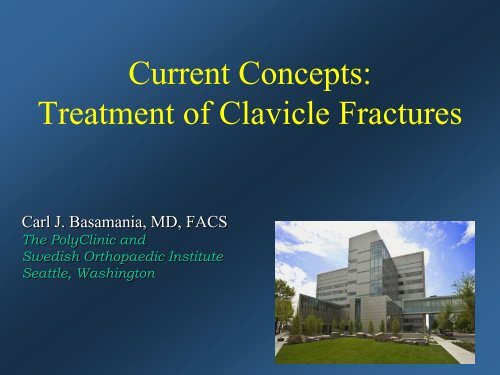 Current Concepts: Treatment of Clavicle Fractures - CMX Travel