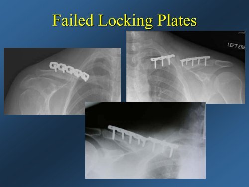 Current Concepts: Treatment of Clavicle Fractures - CMX Travel