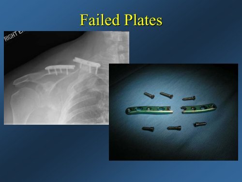 Current Concepts: Treatment of Clavicle Fractures - CMX Travel