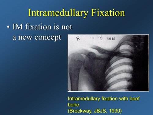 Current Concepts: Treatment of Clavicle Fractures - CMX Travel