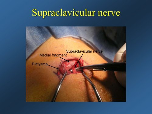 Current Concepts: Treatment of Clavicle Fractures - CMX Travel