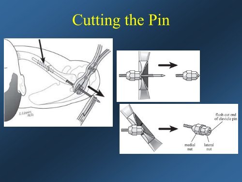 Current Concepts: Treatment of Clavicle Fractures - CMX Travel