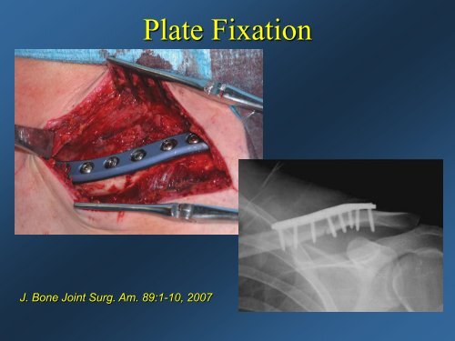 Current Concepts: Treatment of Clavicle Fractures - CMX Travel