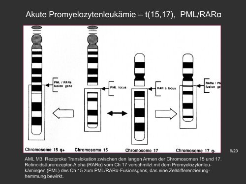 Akute Promyelozytäre Leukämie – AML M3 - Onkopedia