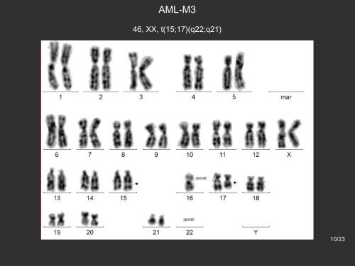 Akute Promyelozytäre Leukämie – AML M3 - Onkopedia