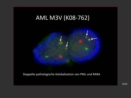 Akute Promyelozytäre Leukämie – AML M3 - Onkopedia