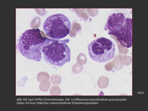 Akute Promyelozytäre Leukämie – AML M3 - Onkopedia