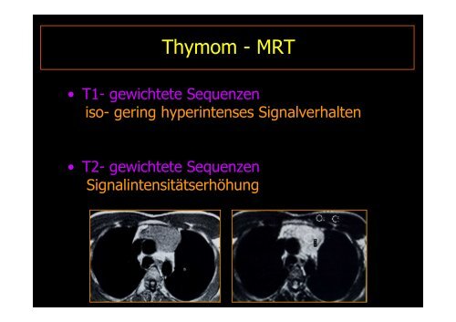 MEDIASTINALTUMORE - Diagnostikum Graz Süd