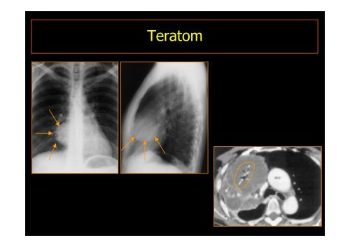 MEDIASTINALTUMORE - Diagnostikum Graz Süd