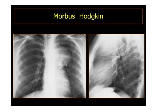 MEDIASTINALTUMORE - Diagnostikum Graz Süd