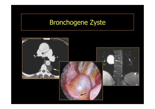 MEDIASTINALTUMORE - Diagnostikum Graz Süd