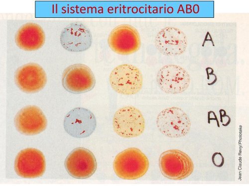 Il sistema eritrocitario AB0