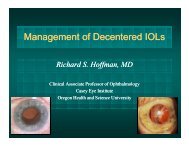 Management of Decentered IOLs