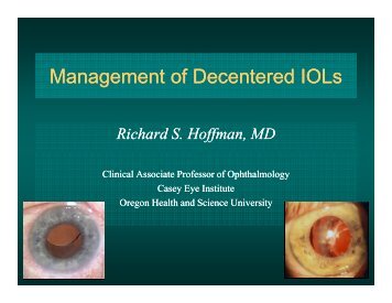 Management of Decentered IOLs