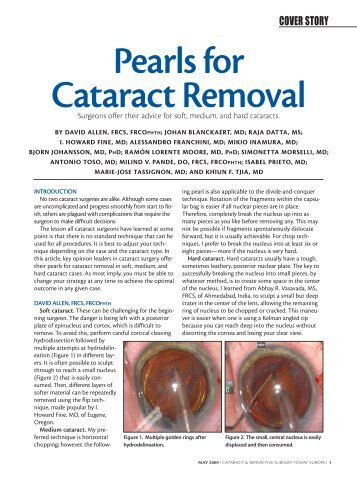 Pearls for Cataract Removal - Drs. Fine, Hoffman and Packer