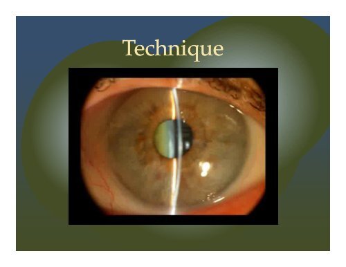 Cataract Surgery in Small Eyes