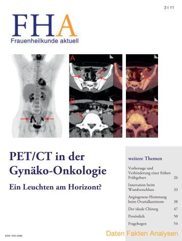 PET/CT in der Gynäko-Onkologie - Frauenheilkunde aktuell