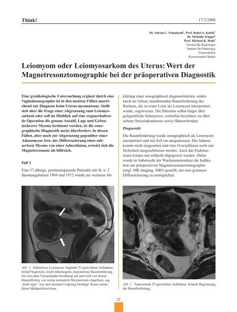 Leiomyom oder Leiomyosarkom des Uterus - Frauenheilkunde aktuell