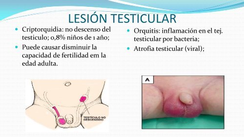 Infertilidad Masculina