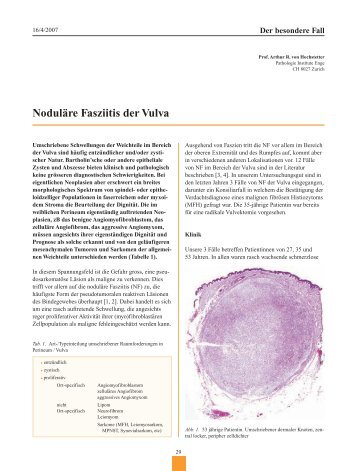 Noduläre Fasziitis der Vulva - Frauenheilkunde aktuell