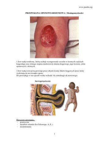 www.pandm.org 1 PRZEPUKLINA OPONOWO-RDZENIOWA ...