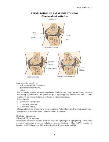Rheumatoid arthritis - Pandm