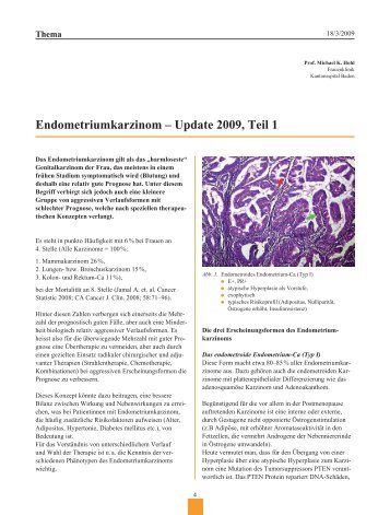 Endometriumkarzinom – Update 2009, Teil 1 - Frauenheilkunde ...