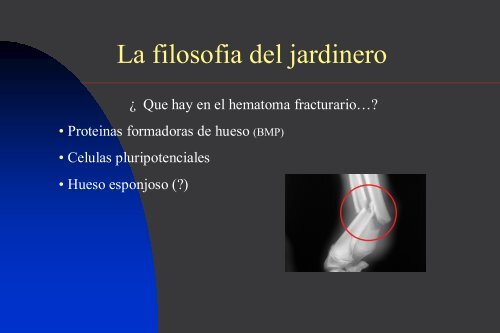 Osteosintesis biologica en el tratamiento de fracturas