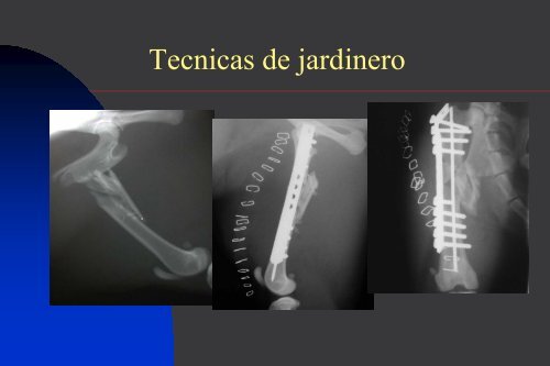 Osteosintesis biologica en el tratamiento de fracturas