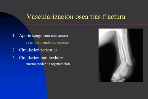 Osteosintesis biologica en el tratamiento de fracturas