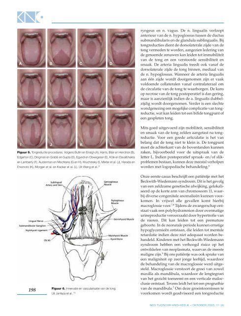 een indicatie voor tongreductie? - Facial Plastic Surgery