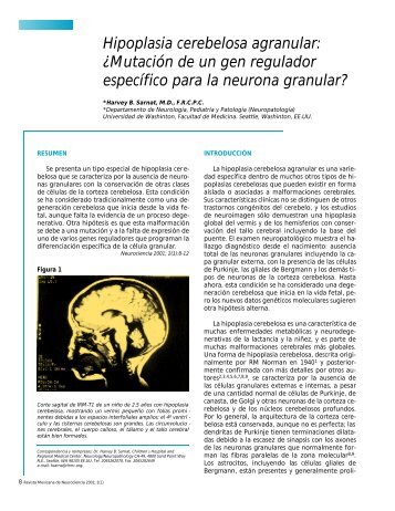 Hipoplasia cerebelosa agranular - Academia Mexicana de Neurología