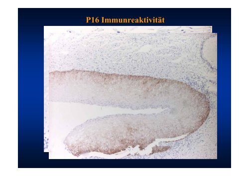 Neoplasien der Cervix uteri: