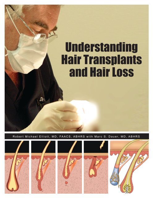 Understanding Hair Transplants and Hair Loss - Pacific Hair