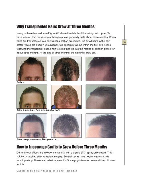 Understanding Hair Transplants and Hair Loss - Pacific Hair