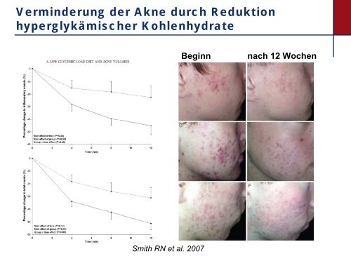 Akne: eine epidemische Hauterkrankung durch westliche ...