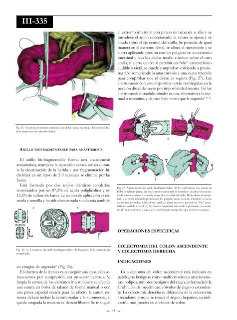 Resecciones colónicas. - Sacd.org.ar