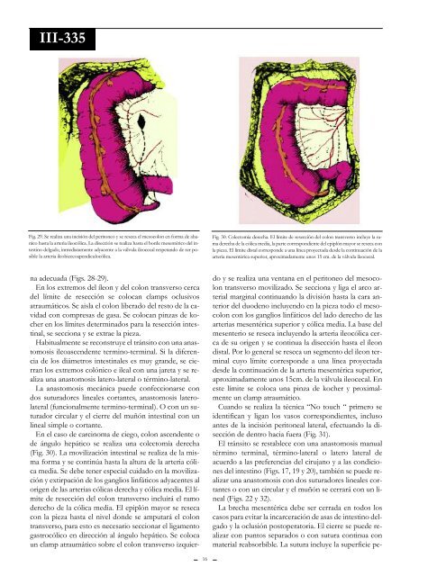 Resecciones colónicas. - Sacd.org.ar