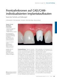 Frontzahnkronen auf CAD/CAM- individualisierten Implantataufbauten