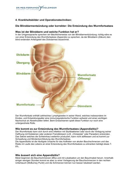 Die Entzündung des Wurmfortsatzes Was ist