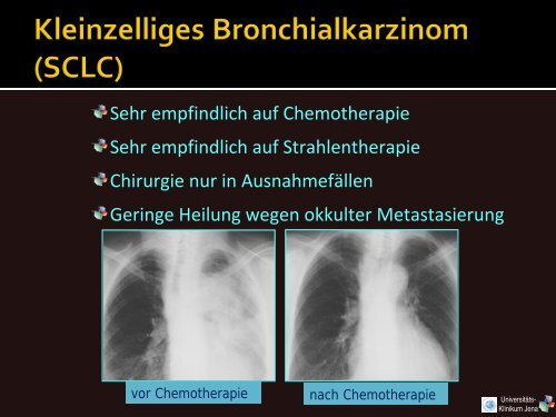 Vorlesung 9. Semester Bronchial-CA - Klinik für Strahlentherapie ...